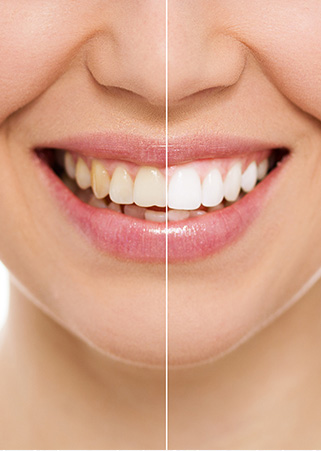 Blanchiment dentaire dans la région de Granby - Pour un sourire éclatent optez pour un blanchiment des dents à Cowansville et Sutton ainsi que à Bromont près de Granby