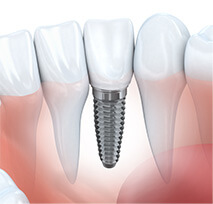 Services d'implantologie à Bromont - Nous offrons le service d'implants dentaires et implant unitaire dans la région de Bromont