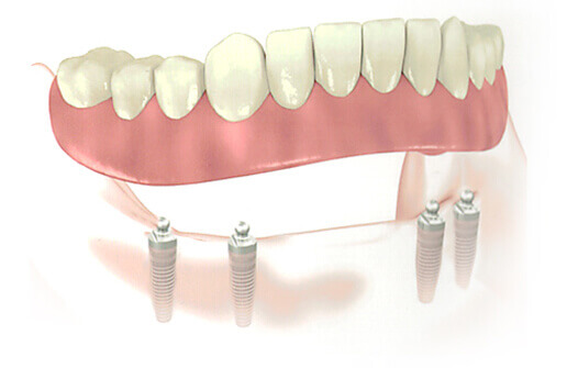 Implantologie dentaire à Bromont et Implantologie dentaire à Sutton - Visitez une de nos trois clinique d'implantologie dentaire