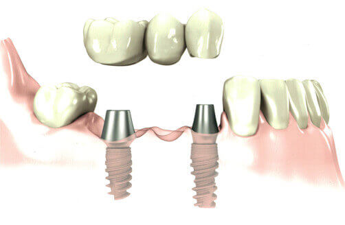 Clinique d'implantologie dentaire près de Granby - Trois cliniques d'implantologie dentaire pour mieux vous servir donc à Cowansville