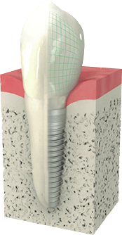 Service d'implantologie dentaire dans nos trois clinique dentaire - Service d'implantologie offert à Cowansville près de Granby